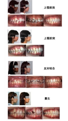 矯正歯科before/after